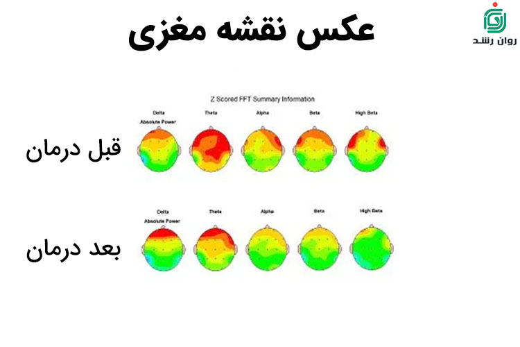 نقشه مغزی برای درمان افسردگی